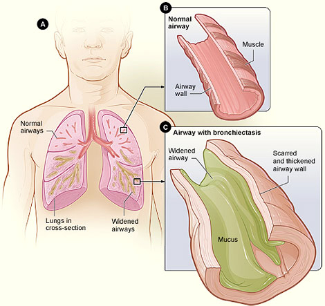 What is bronchiectasis?