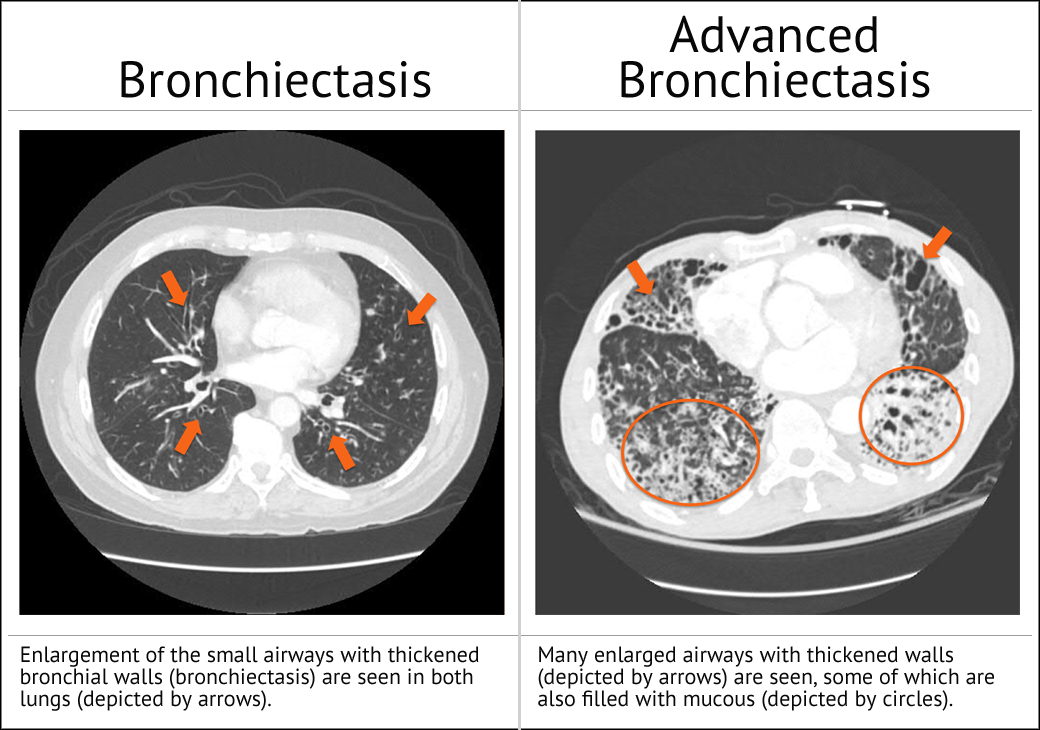 Bronchiectasis Imaging